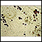 Scabies mite - photomicrograph of the stool