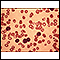 Leucemia linfocítica crônica - visualização microscópica