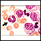 Leucemia mielocítica crônica - visualização microscópica