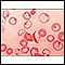 Glóbulos vermelhos, falciformes e pappenheimer