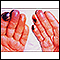 Crioglobulinemia de los dedos