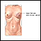 Reconstrucción de seno - serie - Indicaciones (primera parte)