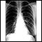 Coccidioidomycosis - chest X-ray