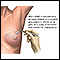 Biopsia abierta del seno