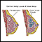 <div class=media-desc><strong>Causes of breast lumps</strong><p>Most breast lumps are benign (non-cancerous), as in fibroadenoma, a condition that mostly affects women under age 30. Fibrocystic breast changes occur in more than 60% of all women. Fibrocystic breast cysts change in size with the menstrual cycle, whereas a lump from fibroadenoma does not. While most breast lumps are benign, it is important to identify those that are not. See your health care provider if a lump is new, persistent, growing, hard, immobile, or causing skin deformities. </p></div>