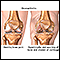 <div class=media-desc><strong>Osteoarthritis</strong><p>Osteoarthritis is a chronic disease of the joint cartilage and bone, often thought to result from wear and tear on a joint, although there are other causes such as congenital defects, trauma and metabolic disorders. Joints appear larger, are stiff and painful and usually feel worse the more they are used throughout the day.</p></div>
