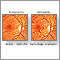 <div class=media-desc><strong>Diabetic retinopathy</strong><p>Diabetes causes an excessive amount of glucose to remain in the blood stream which may cause damage to the blood vessels. Within the eye the damaged vessels may leak blood and fluid into the surrounding tissues and cause vision problems. </p></div>