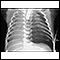 Neumotórax - radiografía de tórax