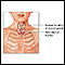 Retrosternal thyroid