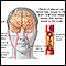 Aterosclerosis de la arteria carótida interna