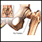 <div class=media-desc><strong>Hip fracture</strong><p>Hip fractures occur as a result of major or minor trauma. In elderly patients with bones weakened by osteoporosis, relatively little trauma, even walking, may result in a hip fracture.</p></div>