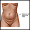 Abdominoplastia - serie