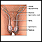 Reparación quirúrgica de la torsión testicular - serie
