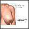 Reducción de mamas (mamoplastia) - serie - Indicaciones