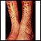 Ictiosis, adquirida - piernas