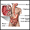 Crohn disease - affected areas