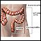 Colitis ulcerativa