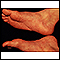 Reactive arthritis - view of the feet