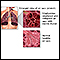 <div class=media-desc><strong>COPD (Chronic Obstructive Pulmonary Disorder)</strong><p>Chronic obstructive pulmonary disease (COPD) refers to chronic lung disorders that result in blocked air flow in the lungs. The two main COPD disorders are emphysema and chronic bronchitis, the most common causes of respiratory failure. Emphysema occurs when the walls between the lung's air sacs become weakened and collapse. Damage from COPD is usually permanent and irreversible.</p></div>