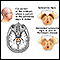 <div class=media-desc><strong>Substantia nigra and Parkinson disease</strong><p>Parkinson disease is a slowly progressive disorder that affects movement, muscle control, and balance. Part of the disease process develops as cells are destroyed in certain parts of the brain stem, particularly the crescent-shaped cell mass known as the substantia nigra. Nerve cells in the substantia nigra send out fibers to tissue located in both sides of the brain. There the cells release essential neurotransmitters that help control movement and coordination.</p></div>