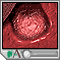 Stomach ulcer