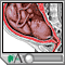 Rupturing membranes