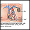 Desfibrilador-cardioversor implantable