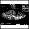 Ultrasonido, placenta normal - Braxton Hicks