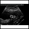 <div class=media-desc><strong>Ultrasound, normal fetus - foot</strong><p>This is a normal ultrasound of a fetus at 19 weeks gestation.  The right foot, including the developing bones, are clearly visible in the middle of the screen.</p></div>