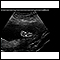 <div class=media-desc><strong>Ultrasound, normal fetus - foot</strong><p>This is a normal ultrasound of a fetus at 19 weeks gestation. The right foot, including the developing bones, are clearly visible in the middle of the screen.</p></div>