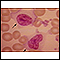 Mononucleosis - microfotografía de la célula