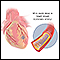 <div class=media-desc><strong>Coronary artery stent</strong><p>An intraluminal coronary artery stent is a small, self-expanding, stainless steel mesh tube that is placed within a coronary artery to keep the vessel open. It may be used during a coronary artery bypass graft surgery to keep the grafted vessel open, after balloon angioplasty to prevent reclosure of the blood vessel, or during other heart surgeries.</p></div>