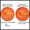 Diabetic retinopathy