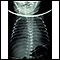 Totally anomalous pulmonary venous return - X-ray