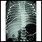 Retorno venoso pulmonar total anómalo - rayos X