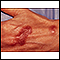 Infección por Mycobacterium marinum en la mano