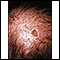 Queratosis actínica en el cuero cabelludo