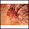 Cáncer de piel - carcinoma de célula basal pigmentado