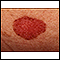 Cáncer de piel - carcinoma de célula basal en propagación