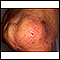 Dermatitis - herpetiforme en la rodilla