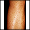 Foliculitis en la pierna