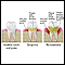 Periodontitis