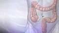 Detección sistemática del cáncer de colon