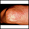 Granuloma annulare on the elbow