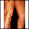 Livedo reticularis en las piernas
