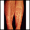 Granuloma annulare on the legs