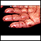 Dermatitis herpetiforme en la mano