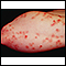 Dermatitis herpetiformis on the forearm