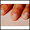 Enfermedad de Kawasaki - exfoliación de las puntas de los dedos