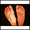 Síndrome de Sturge-Weber - plantas de los pies